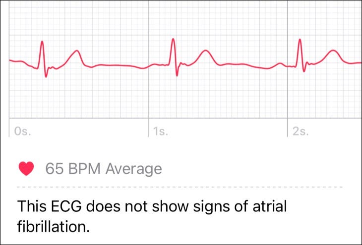 aw_af_ecg